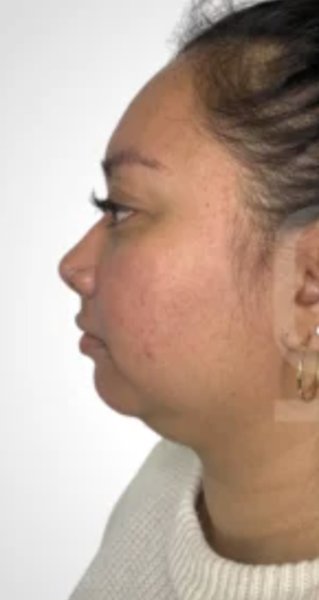 Before chin sculpting treatment