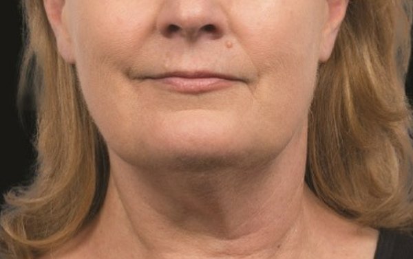 After chin sculpting treatment