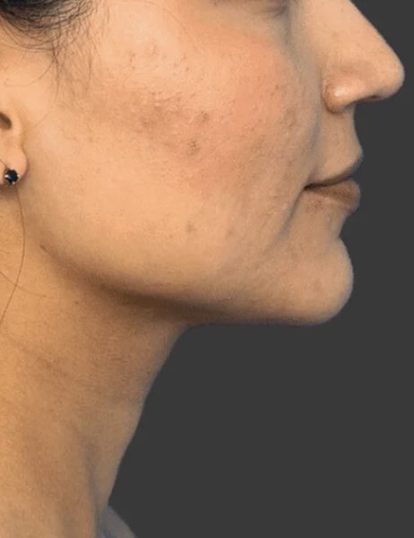After chin sculpting treatment