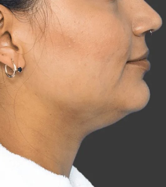 Before chin sculpting treatment