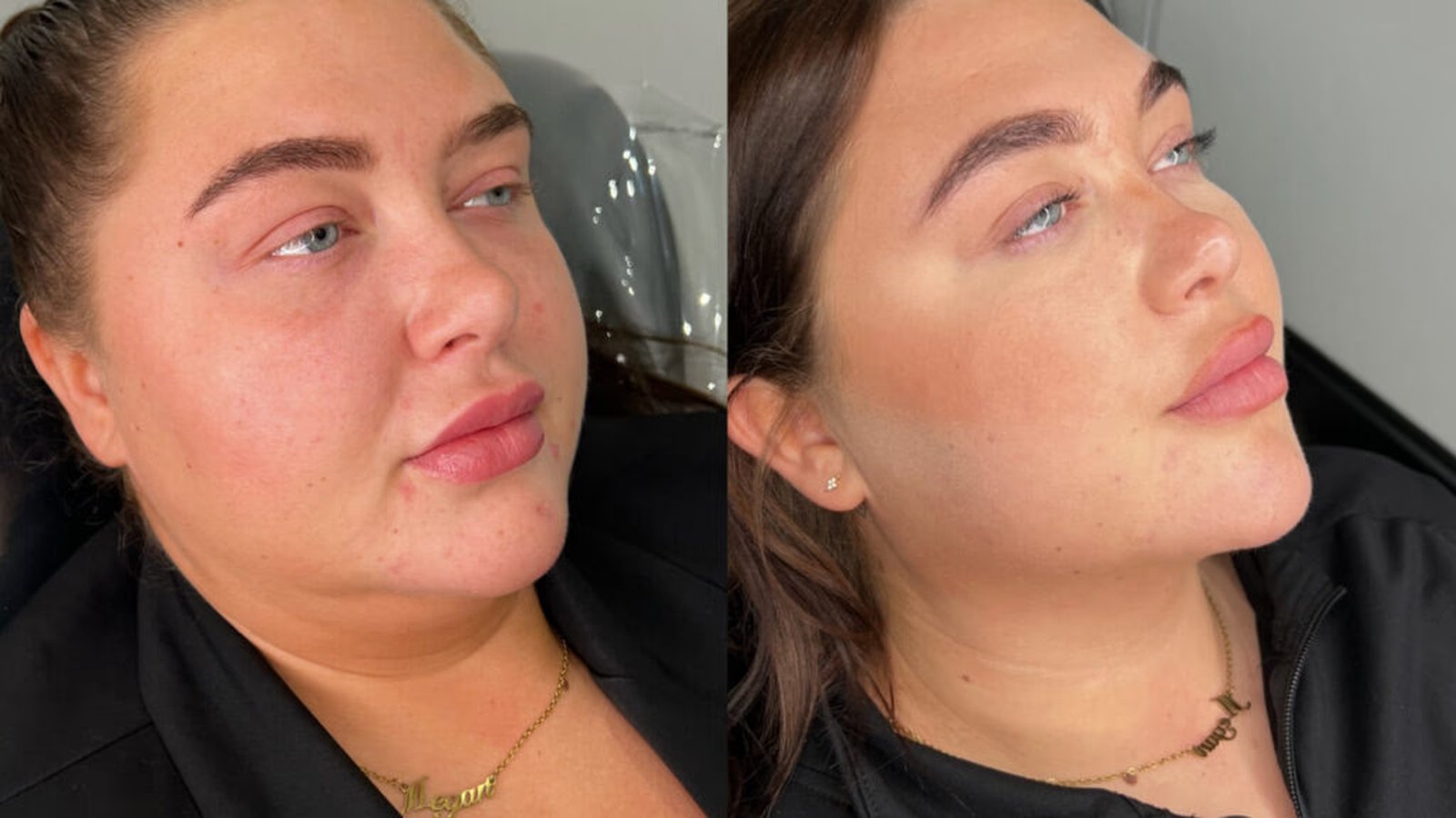 Chin and jawline sculpting results